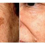 POZNATI DERMATOLOG OTKRIO: Ovo je uloga sode bikarbone u liječenju mrlja na licu!