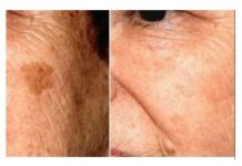 POZNATI DERMATOLOG OTKRIO: Ovo je uloga sode bikarbone u liječenju mrlja na licu!