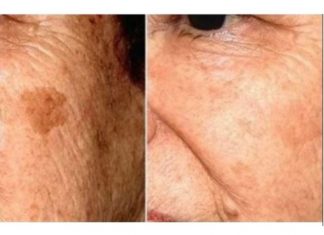 POZNATI DERMATOLOG OTKRIO: Ovo je uloga sode bikarbone u liječenju mrlja na licu!