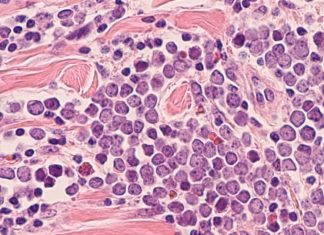 Ova vrsta izuzetno agresivnog karcinom javlja se najčešće kod ljudi preko 50 godina: Brzo se širi, a vrlo teško se otkriva, evo kako ga prepoznati