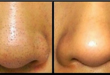 Trik koji garantovano radi: Riješite se mitesera s cijelog lica za deset minuta