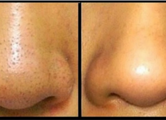 Trik koji garantovano radi: Riješite se mitesera s cijelog lica za deset minuta