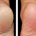 ZA MEKA STOPALA POTREBNA SU VAM SAMO 3 SASTOJKA IZ KUHINJE: Potopite noge u ovu smjesu na 15 minuta i recite zbogom ispucalim petama