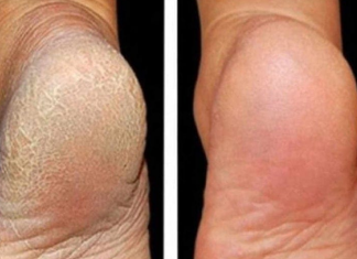 ZA MEKA STOPALA POTREBNA SU VAM SAMO 3 SASTOJKA IZ KUHINJE: Potopite noge u ovu smjesu na 15 minuta i recite zbogom ispucalim petama