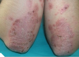 Prirodni lijek za psorijazu: biljne mješavine melema i čajeva (RECEPT)