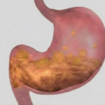 Prirodni pristup ublažavanju gastritisa i bolova u želucu