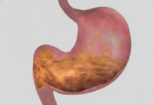 Prirodni pristup ublažavanju gastritisa i bolova u želucu