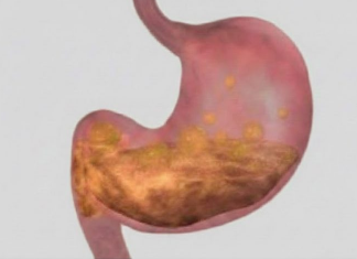 Prirodni pristup ublažavanju gastritisa i bolova u želucu