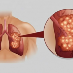 PUŠAČI, PAŽNJA! Za 3 dana izbacite sve otrove iz tijela: Ova metoda skida OTROV SA ZIDOVA PLUĆA, sprečava rak, izbacuje masnoće i višak vode!