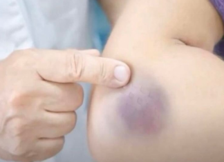 NIKAD NE BISTE POGODILI ZAŠTO SE MODRICE JAVLJAJU PO TIJELU: Nema Veze Sa POVREDAMA, PRAVI RAZLOG ĆE VAS ŠOKIRATI