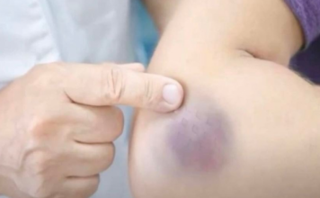 NIKAD NE BISTE POGODILI ZAŠTO SE MODRICE JAVLJAJU PO TIJELU: Nema Veze Sa POVREDAMA, PRAVI RAZLOG ĆE VAS ŠOKIRATI