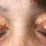 STAVILA SAM OVU NAMIRNICU NA MASNO TKIVO KOD OKA, ono je preko noći nestalo: EVO ŠTA ME SPASILO, SVI GA IMATE U KUĆI