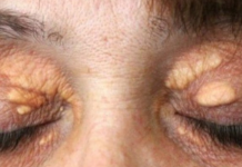 STAVILA SAM OVU NAMIRNICU NA MASNO TKIVO KOD OKA, ono je preko noći nestalo: EVO ŠTA ME SPASILO, SVI GA IMATE U KUĆI