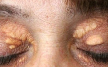 STAVILA SAM OVU NAMIRNICU NA MASNO TKIVO KOD OKA, ono je preko noći nestalo: EVO ŠTA ME SPASILO, SVI GA IMATE U KUĆI