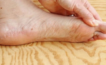 7 znakova da se tijelo već duže vrijeme bori s VISOKIM ŠEĆEROM U KRVI: Prvo ćete to primijetiti na očima i nogama!