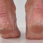 Jeftino čudo iz kuhinje koje spašava vaša stopala: Kao rukom rješava ispucale peta, gljivice i kurje oči