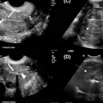 OD RAKA MATERICE UMIRE SVE VEĆI BROJ ŽENA: 6 jasnih signala da se u tijelu razvija ovaj opasan tumor!
