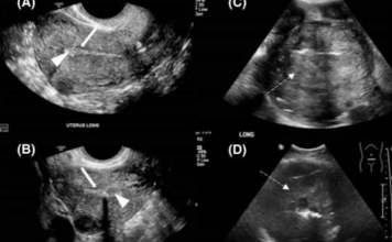 OD RAKA MATERICE UMIRE SVE VEĆI BROJ ŽENA: 6 jasnih signala da se u tijelu razvija ovaj opasan tumor!