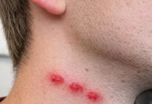 Ujedi u ravnoj liniji na koži mogu ukazivati na jedan problem u domu: Evo kako ih prepoznati i šta treba uraditi
