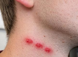 Ujedi u ravnoj liniji na koži mogu ukazivati na jedan problem u domu: Evo kako ih prepoznati i šta treba uraditi