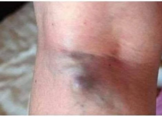 NAMIRNICE KOJE POVEĆAVAJU RIZIK OD TROMBOZE, JEDNA POSEBNO: Jedemo ih svakoga dana, a štete arterijama