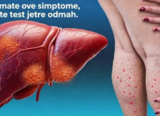 DA LI JE VAŠA JETRA U OPASNOSTI? Ovo je 12 ranih znakova ciroze jetre koje ne smete da ignorišete