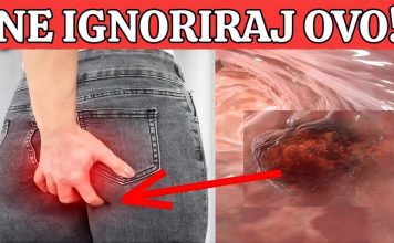 R@k debelog crijeva! UpozoravajućI znakovi I simptomi koje nikada ne smijete ignorirati.